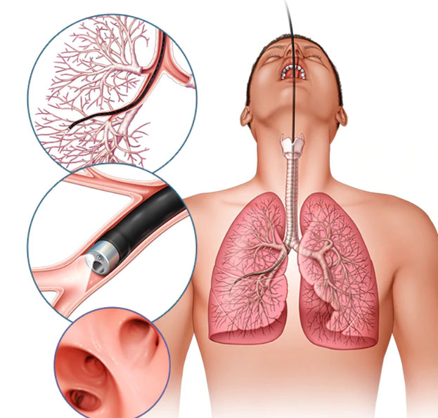 Bronchoscopy